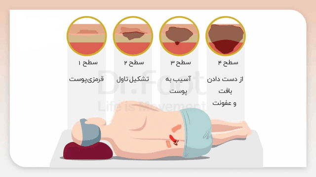 زخم بستر، پیشگیری و راهکارهای درمان