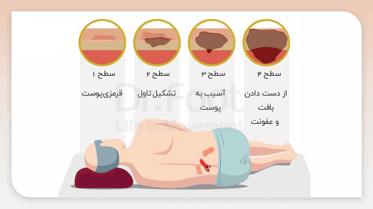 زخم بستر، پیشگیری و راهکارهای درمان